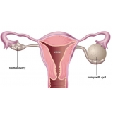 Arquivos Cistos de Ovários - Scope Ginecologia